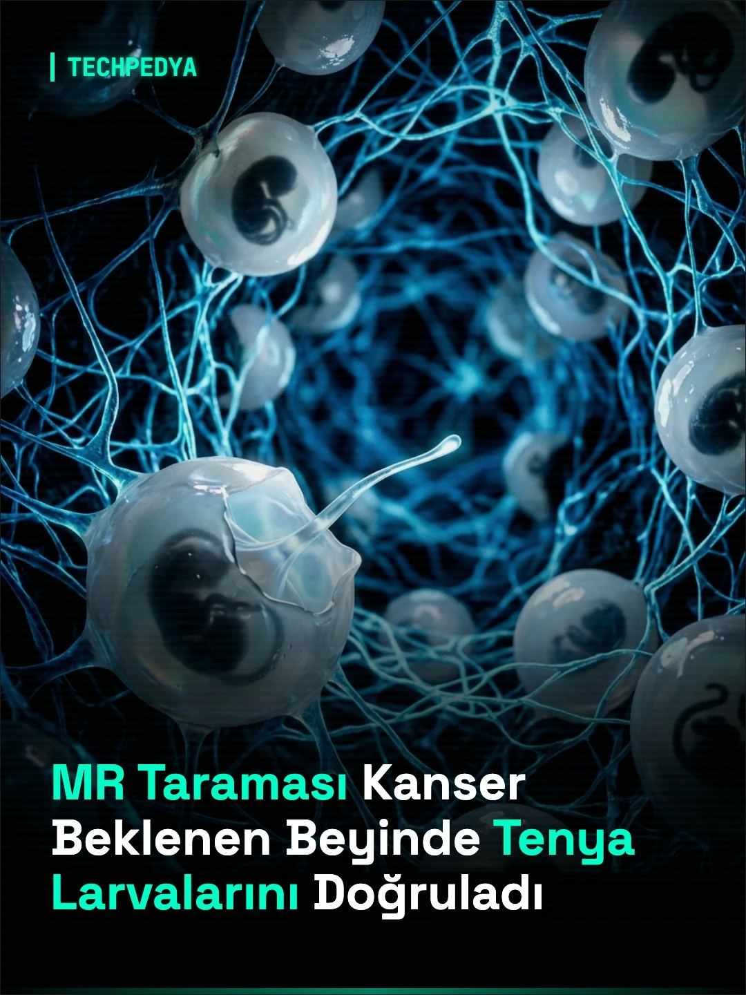 MR Taraması Kanser Beklenen Beyinde Tenya Larvalarını Doğruladı